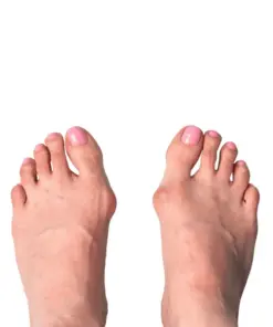 Hallux Valgus